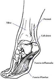Dolor En El Talon Talalgia Fascitis Plantar Tritim Triatlon Rosario