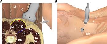 A variation on mckenzie side bending exercises; Randomized Trial Of Ultrasound Guided Superior Cluneal Nerve Block Regional Anesthesia Pain Medicine