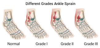 A grade 2 sprained ankle is a step above a grade 1 sprained ankle and is several steps below a grade 3 sprained ankle. Sprained Ankle Injury Treatment Recovery Time
