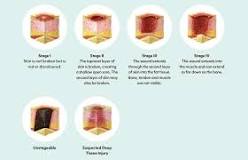 How Medical Airflow Mattresses Relieve Pressure Ulcers ...