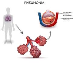 From pneumonia to neoplasia, torsion to hypertension, this article explores and explains common pulmonary diseases in dogs. Walking Pneumonia Versus Pneumonia
