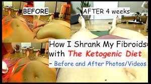 Ketosis is a natural function of. How I Ve Shrunk My Fibroids With The Ketogenic Diet Before After Photos And Videos Youtube