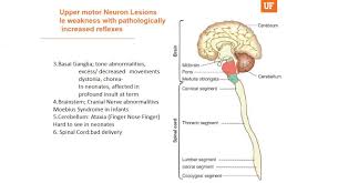 Upper Motor Neuron Weakness Utilizing Different Forms Of Cerebral Palsy As Examples Division Of Pediatric Neurology College Of Medicine University Of Florida It is also known as a plantar interdigital neuroma. upper motor neuron weakness utilizing