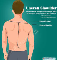 Uneven Shoulder Neck And Shoulder Muscles Posture Exercises Muscle Imbalance