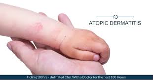 Image result for dermatitis contacta children