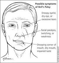 Symptoms of bell's palsy, which vary from person to person and range in severity from mild weakness to total paralysis, may include twitching, weakness, or paralysis on one or both sides of the face, drooping of the eyelid and corner of the mouth, drooling, dryness of the eye or mouth, impairment of taste, and excessive tearing in one eye. Bells Palsy Physio Treatments Dublin Physiotherapy Clinic