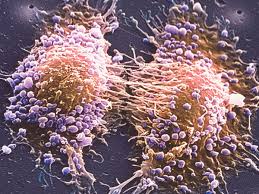Survival rates for prostate cancer. Tall Men At Bigger Risk Of Aggressive Prostate Cancer Study Suggests Prostate Cancer The Guardian