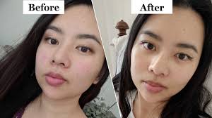 Once the muscles are paralyzed, the skin on the surface relaxes taking the wrinkles. I Tried Masseter Botox To Treat My Jaw And Teeth Grinding Glamour