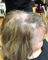 Lichen planus is a pathology that, although relatively little known, affects many people; Lichen Planopilaris Lucinda Ellery Hair Loss Consultancy La And Nyc