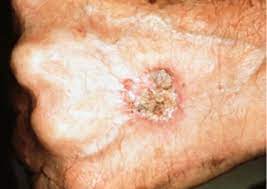 The major types of skin cancer are melanoma, squamous cell carcinoma, and basal cell carcinoma.for the most part, skin cancer occurs on the parts of skin typically exposed to the sun, such as on the face or arms, but it can also appear on other areas. Squamous Cell Carcinoma Warning Signs And Images The Skin Cancer Foundation