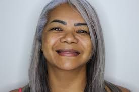 Coroas Emax sobre implante! Caso feito com scanner digital para maior  conforto e agilidade para confecção das coroas. #implante #implantedentário  #odonto #odontologia #dentista #reabilitacao