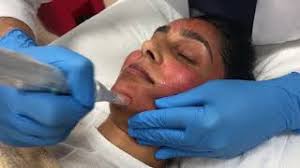 Uneven skin texture is commonly a result of excess dead skin cells that build up on the surface of the skin, explains frank. Microneedling Treats Fine Lines Enlarged Pores And Uneven Skin Texture Youtube