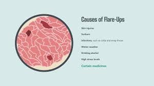 Researchers think something sets off your immune system. Psoriasis Signs Symptoms Causes And Treatment Merck Manual Consumer Version Youtube