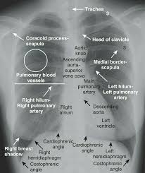 Chest X Ray Anatomy Medical Anatomy Radiology Student Medical Pictures