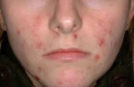 Pimple Scab Popped Get Rid Of Acne Scabs Fast Overnight Cover Heal Scab On Pimples Quickly Acne Scab Acne Cure Cystic Acne Cure