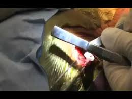 How To Perform Insertion Of A Ventriculo Peritoneal Shunt Youtube