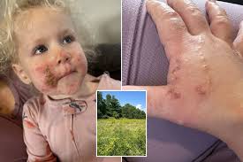 Mum's warning after toddler's face erupted in 'red, angry blisters' in  garden