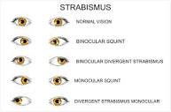What is Strabismus (Squint)?