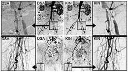 Merkely béla péter (budapest, 1966. Digital Variance Angiography Wikipedia