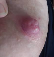 When Breastfeeding Hurts Nipple Blebs Mattos Lactation