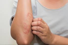 Psoríase pustulosa é uma forma incomum. Saude Rj Viver Melhor Psoriase Saiba Mais Sobre A Doenca