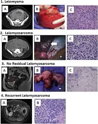 Image result for Leiomyosarcoma