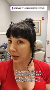 24 hours post PhotoFacial (pigment darkens) and 2 weeks post (darkened  pigment has shed with exfoliation or begins to shed naturally). I have  about 1/3 more even skin tone, some spots are gone some ...