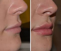 Lip augmentation procedure and lip filler aftercare. Lip Fillers Before And After Uk Lip Fillers Cost Lip Fillers Free Consultation
