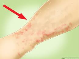 How To Treat Pinpoint Petechiae: 10 Steps (With Pictures)