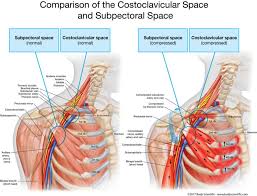 Why Surgery For Thoracic Outlet Syndrome