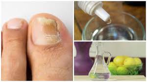 Prepara Tu Propio Remedio Rompehongos Para Las Unas