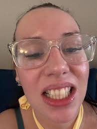 Alternatives to veneers for perfecting teeth?