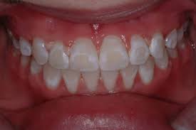 There are several different approaches to treating white spots. Teeth Have White Spots What Can Be Done Mcomie Dentistry