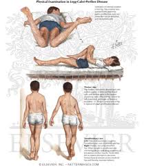 Image result for Perthes Test