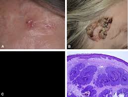 Check spelling or type a new query. Basal Cell Carcinoma Journal Of The American Academy Of Dermatology