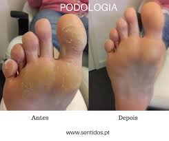 Calos Nos Pés Olho De Peixe Pin De Multiskazka Em Hudozhestvennye Illyustracii Em 2020 Cuidados Com Os Pes Saude E Beleza Tratamento Corporal
