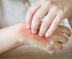 Image result for skin rash acute hiv infection
