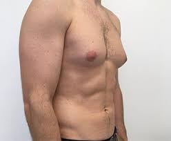 This is commonly caused due to the increased level of estrogen than testosterone levels in males. Enlarged Breasts In Men Gynecomastia Nogyno