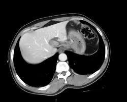 The gallbladder stores bile produced by the liver. Intrahepatic Biliary Stones Radiology Case Radiopaedia Org