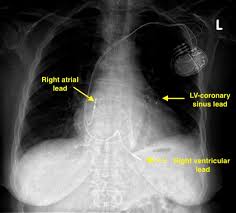 This device uses a battery to function and usually it monitors the rate of. Pacemaker Terminology Questions And Answers In Mri