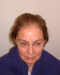 Forum beiträge / themen letzter beitrag; Haartransplantation Forum Alopezie Shefalitayal