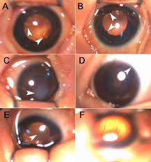 Image result for Red Reflex