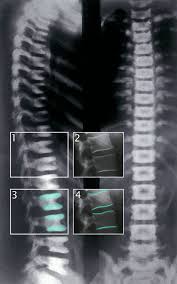 Paget Disease Of Bone Amboss