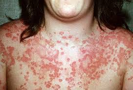 The most common signs and symptoms of drug allergy are hives, rash or fever. Allergic Reaction Anaphylaxis Rash Dx2 Training Solutions