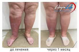 Limfostaz Limfedema Slonovost Otek Nizhnih I Verhnih Konechnostej