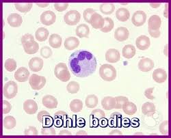 When you see toxic granules and dohle bodies in the neutrophils what does that indicate? Myelodysplastic Syndrome Ask Hematologist Understand Hematology