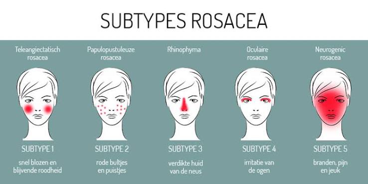Alles wat je moet weten over rosacea | Rositta Kliniek