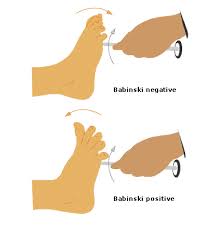 Image result for Babinski Reflex