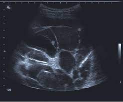 Watch this interesting case of loculated pleural effusion which was difficult to tap was effectively managed by our pleuroscopy technique and adhesions. Ultrasound Image Of Multiple Septations And Loculations In A Patient Download Scientific Diagram