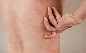 Image result for Hives